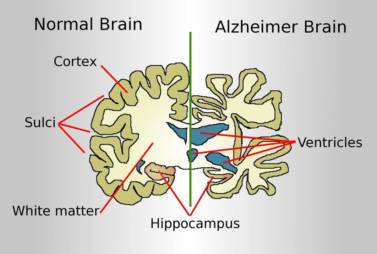Dibujo comparando el cerebro de un paciente con Alzheimer y un cerebro normal