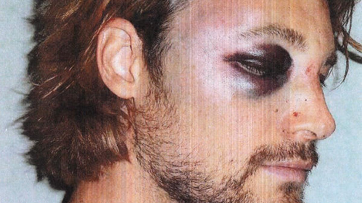 Gabriel Aubry, con la cara desfigurada.