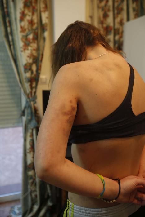 La mujer violada por su jefe en València muestra las heridas sufridas en el ataque.