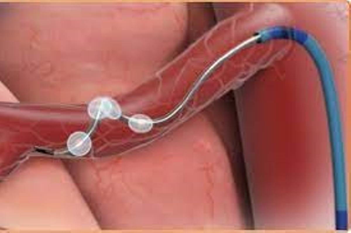 Una punción mínimamente invasiva permite acceder a la arteria femoral.