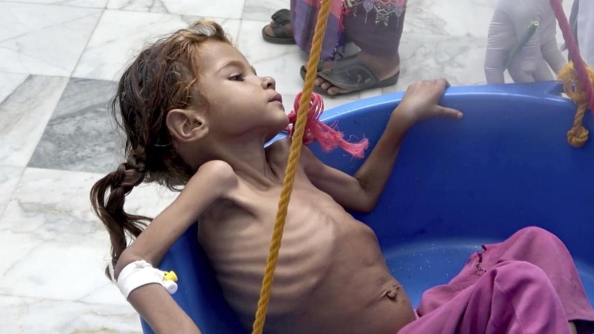 Una niña sufre las consecuencias de la extrema pobreza en Yemen.