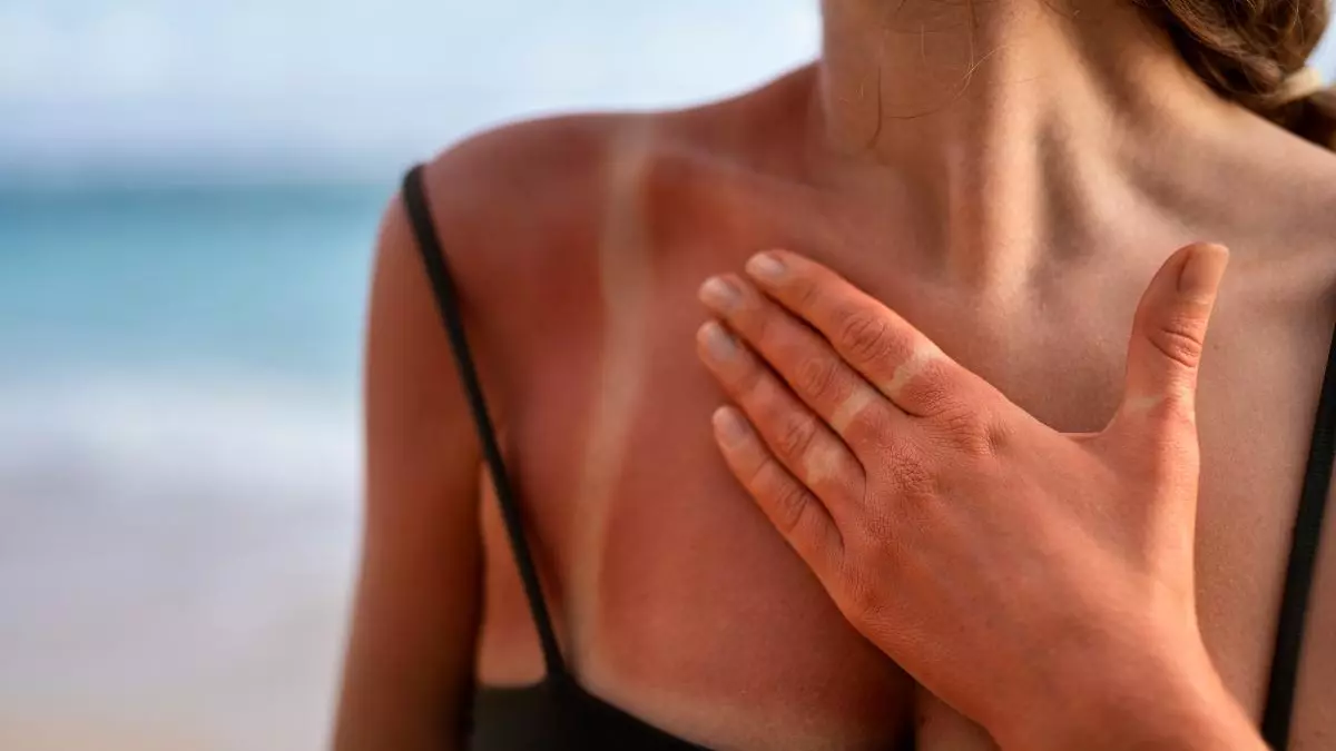 Quemaduras solares: cómo acelerar la recuperación de la piel tras una exposición intensa al sol