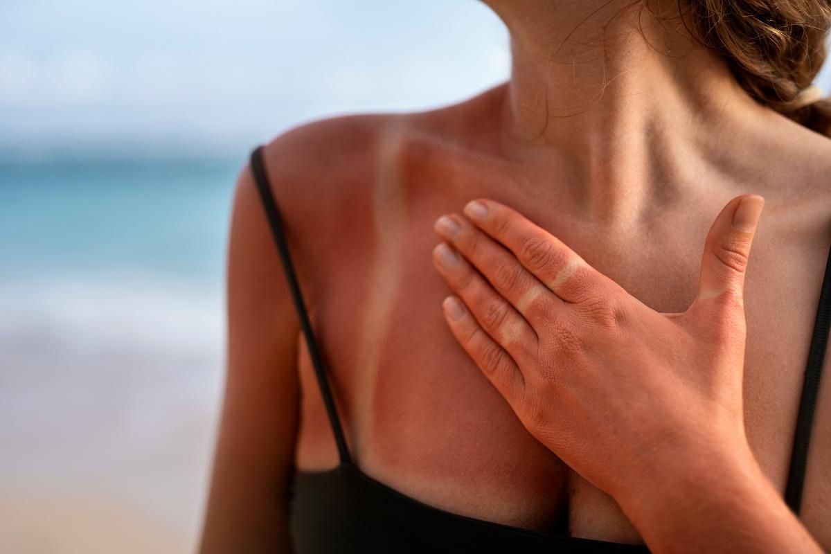Todo lo que necesitas saber para aliviar las molestias de las quemaduras solares en verano