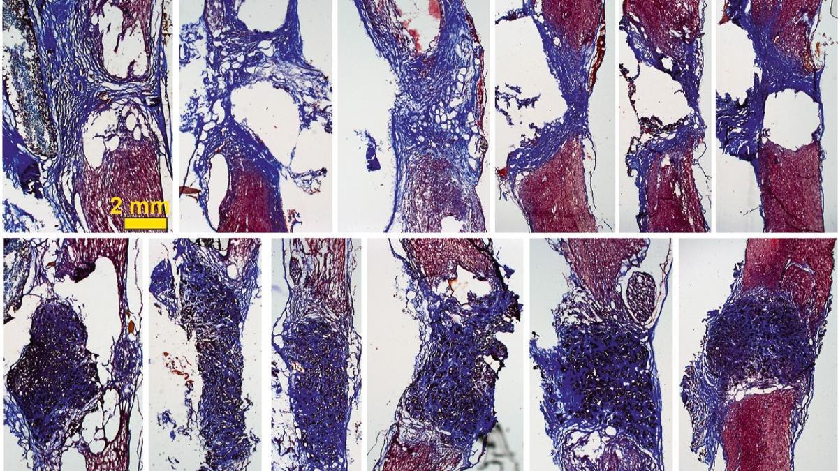Los tejidos de nuevo crecimiento ‘colonizan’ el espacio de la lesión en la médula espinal gracias a la espuma.