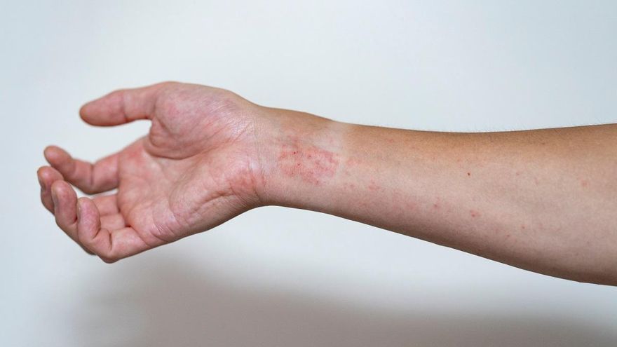 Consejos para aliviar los síntomas de la dermatitis atópica, que se agrava con el frío