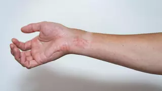 Consejos para aliviar los síntomas de la dermatitis atópica, que se agrava con el frío