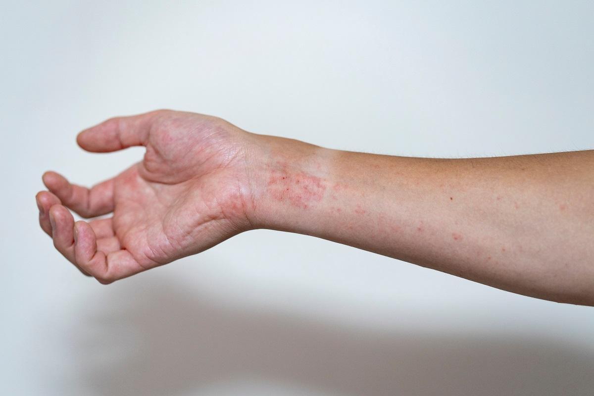 Los síntomas de la dermatitis atópica pueden afectar a la autoestima del paciente.