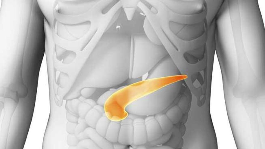 Cada año se diagnostican 2.000 casos de pancreatitis crónica.