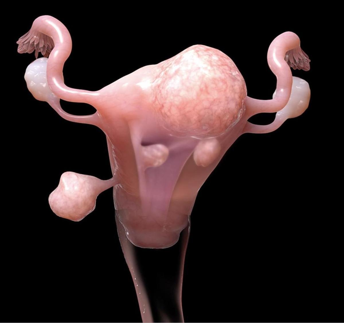 Imagen digital de un útero con los tres tipos de miomas más frecuentes en sus localizaciones.