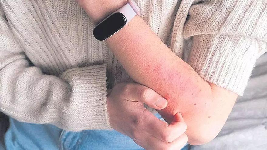 ¿Qué síntomas provoca la sarna? ¿Cómo puede prevenirse?