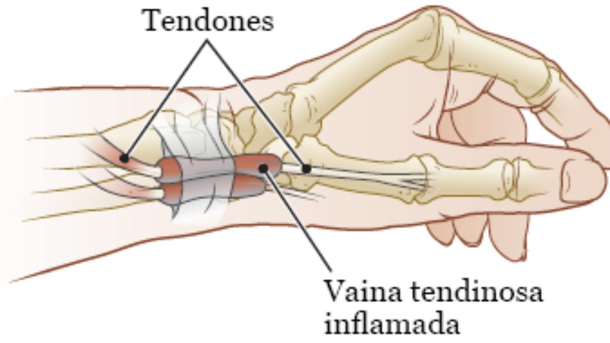 Muñeca con tenosinovitis de De Quervain