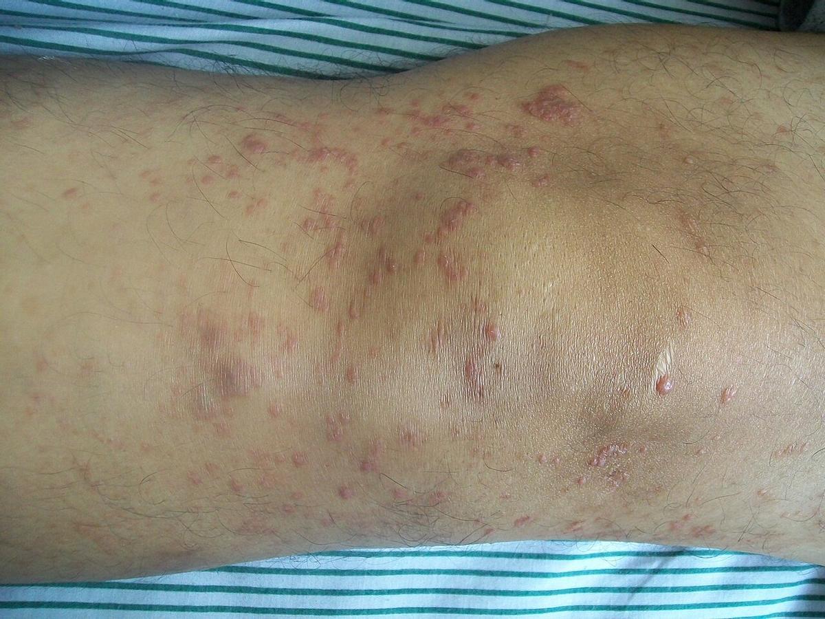 La micosis fungoide afecta principalmente a la piel en sus etapas iniciales.