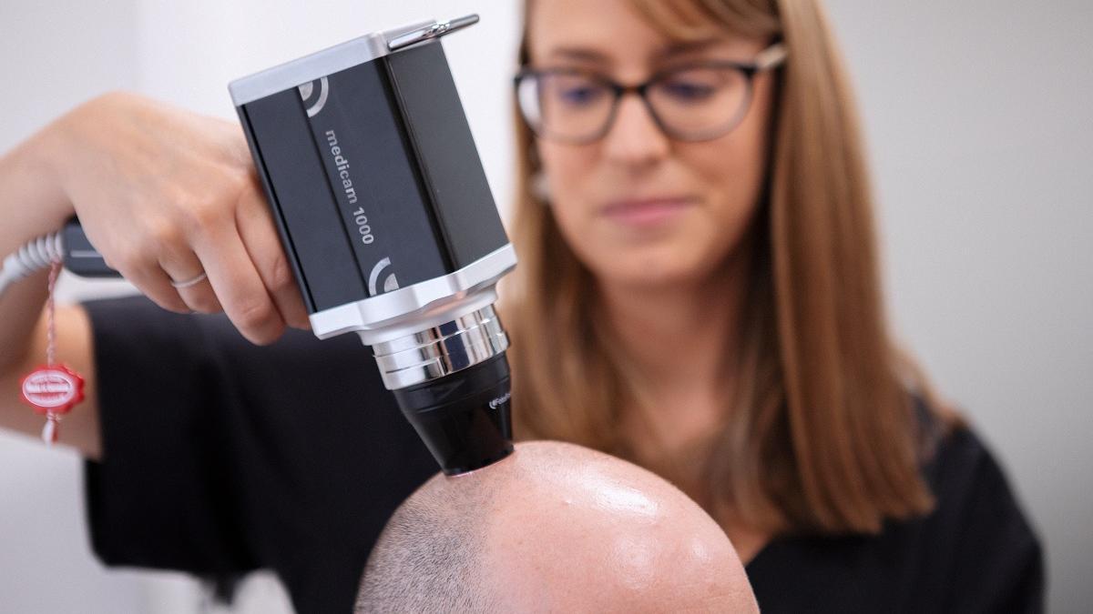 La clínica dermatológica IMR trató 5.000 casos de alopecia femenina y masculina en 2022.