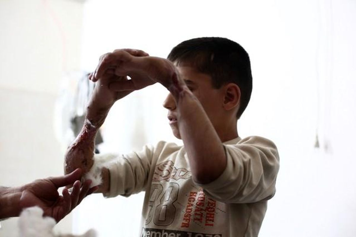 Bassam, un nen d’11 anys, eleva el seu braç destrossat en un bombardeig mesos enrere, mentre espera tractament a l’hospital improvisat a Duma.