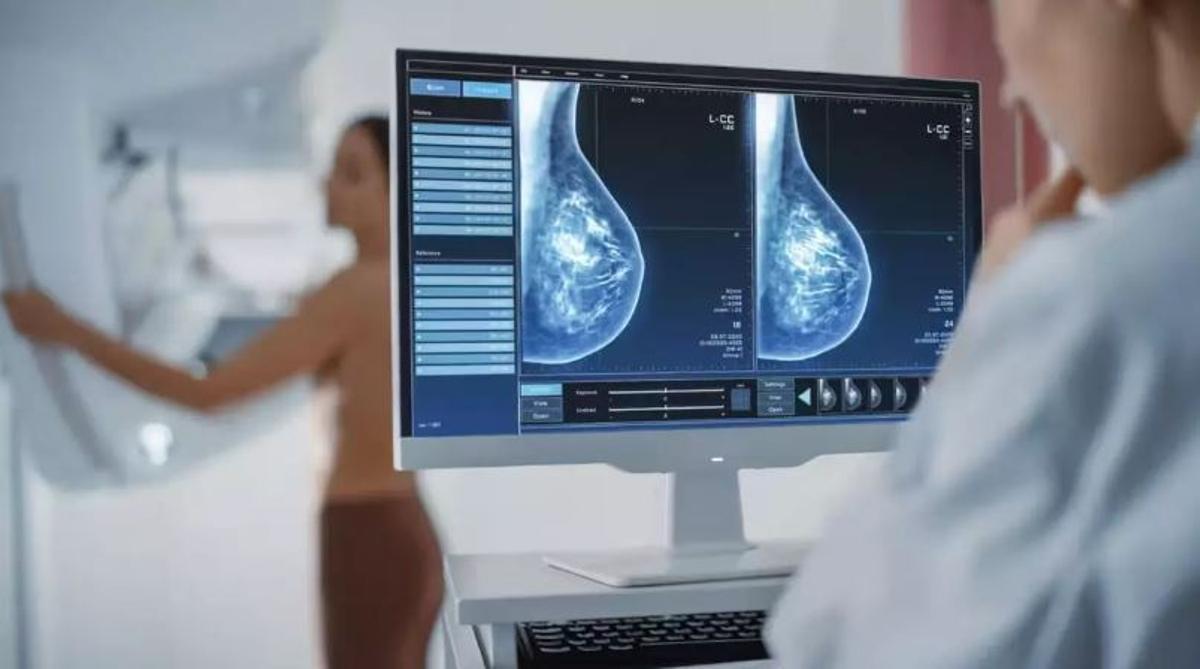Las mujeres mayores de 45 años deben realizarse mamografías en aras de la detección precoz del cáncer de mama.