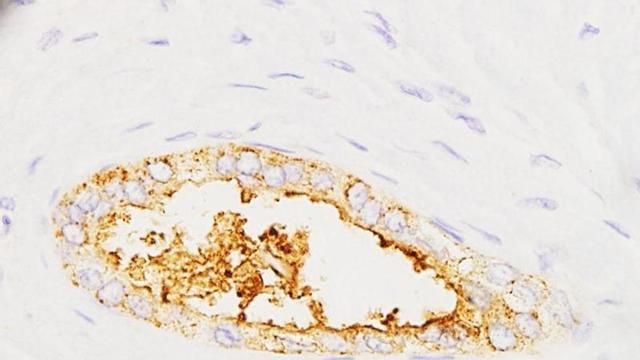 Expressió de la proteïna sAXL en tumors pancreàtics.