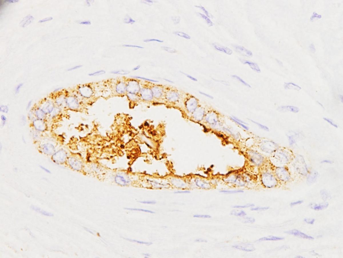Expresión de la proteína sAXL en tumores pancreáticos.