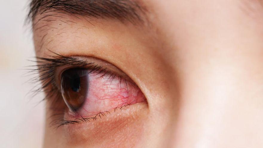 Conjuntivitis, el nuevo síntoma que indica que puedes estar contagiado de Ómicron