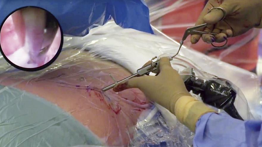 La endoscopia de columna, la alternativa mínimamente invasiva a la cirugía tradicional
