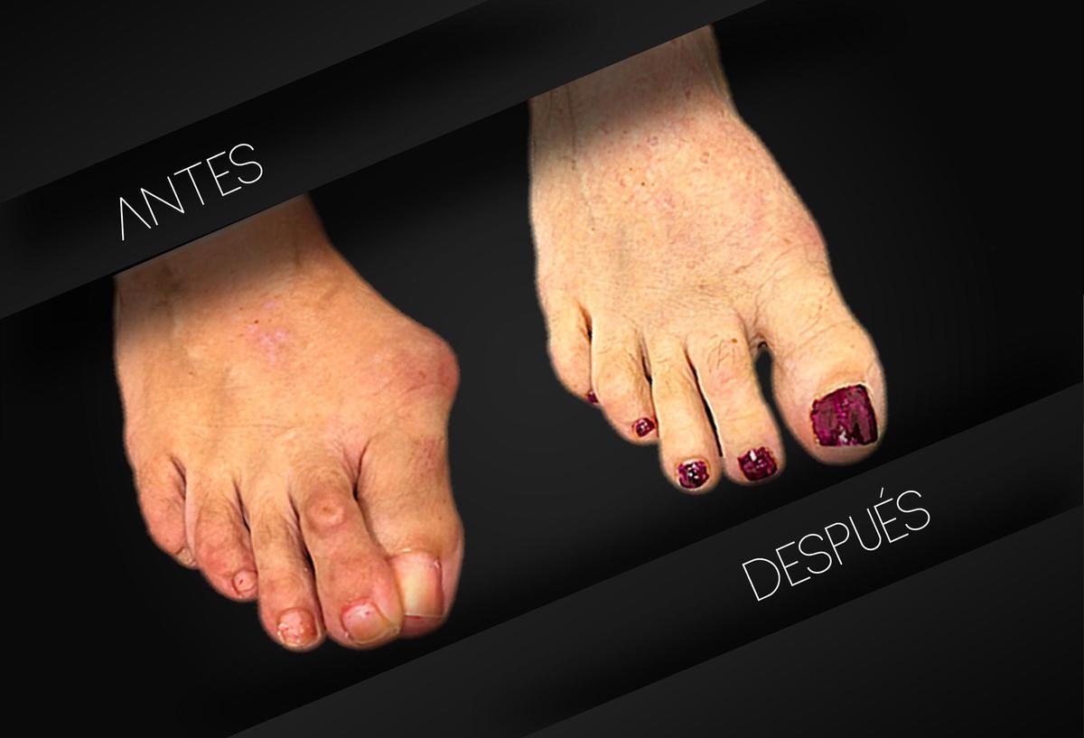 Resultado de intervención de juanete y dedos tras cirugía MIS.