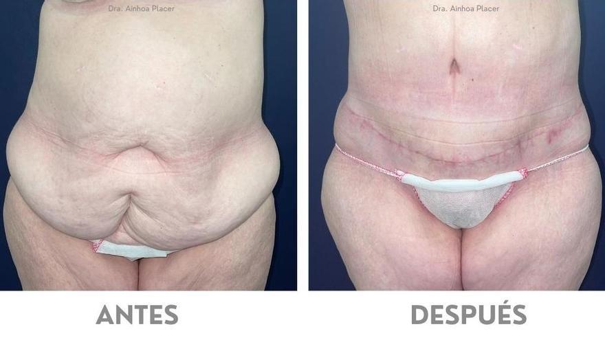 Paciente de la clínica de cirugía estética tras liposucción y abdominoplastia