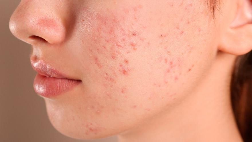 Los batidos que ayudan a evitar acné: Mejora tu piel con estos jugos fáciles de preparar