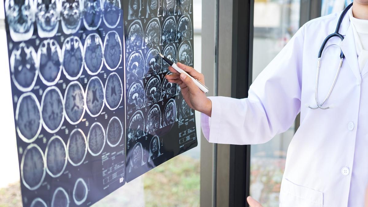 os tumores cerebrales suponen aproximadamente el 2% de todos los cánceres diagnosticados en adultos.