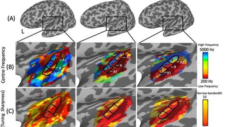 Las pruebas demostraron que el cerebro de los músicos con «oído perfecto» (AP en el dibujo) tenía una corteza auditiva mayor que el resto de músicos y de voluntarios con mínimas nociones musicales