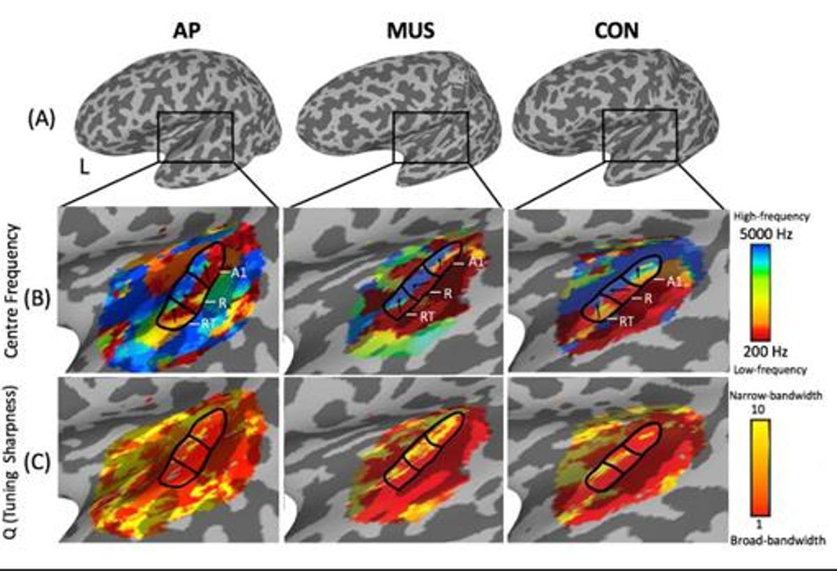 Las pruebas demostraron que el cerebro de los músicos con «oído perfecto» (AP en el dibujo) tenía una corteza auditiva mayor que el resto de músicos y de voluntarios con mínimas nociones musicales
