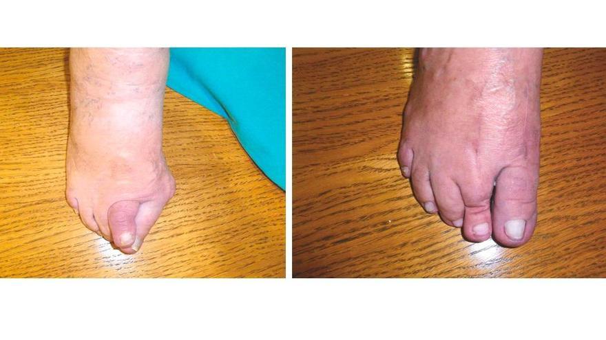 A la izquierda, imagen de un pien antes de operar; y, a la derecha, el mismo pie después de la operación en Clínica Astur