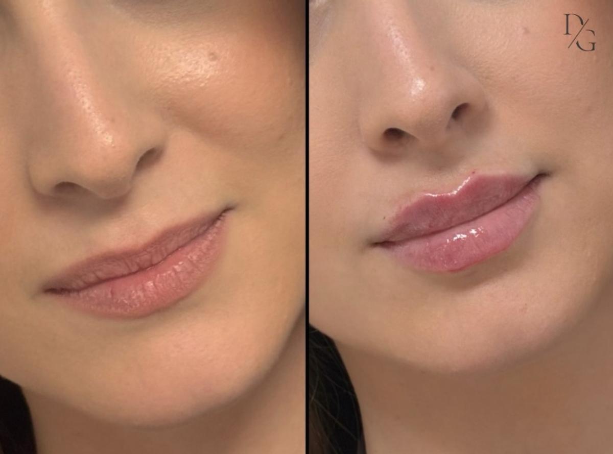 Resultado de un tratamiento de labios realizado por Daynier Herrera.