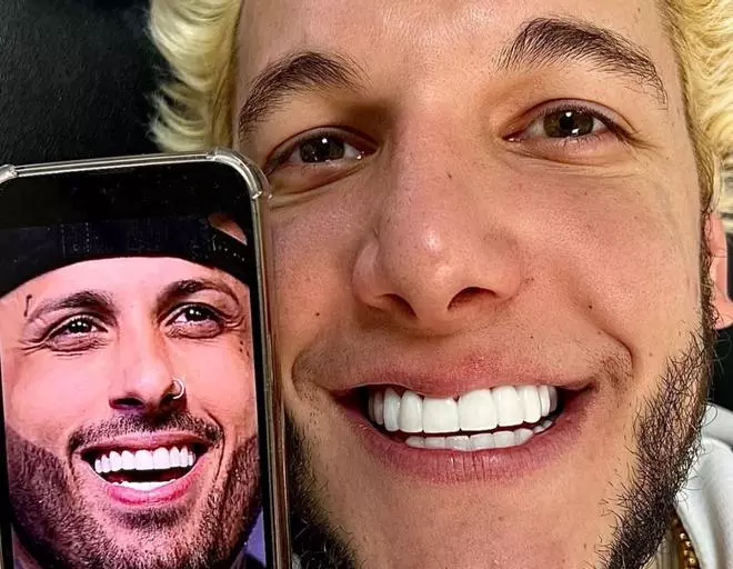 La foto más impactante de los dientes de Álex Caniggia ('GH VIP 8')