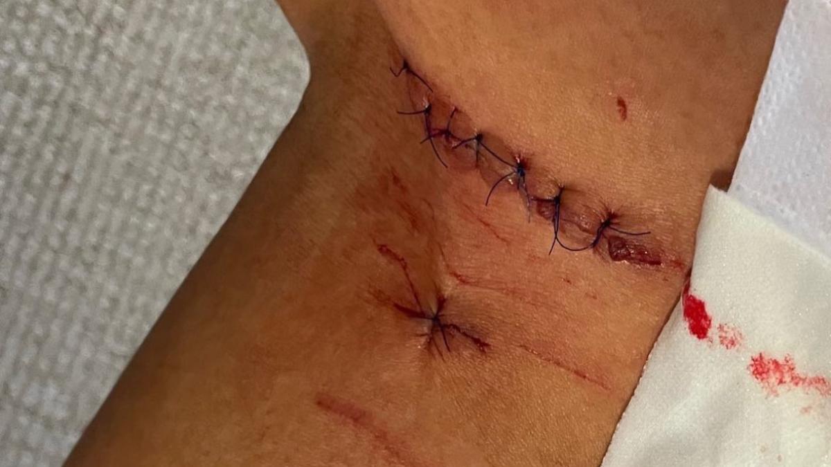 Espectacular imagen de la pierna dañada de Águeda Marqués