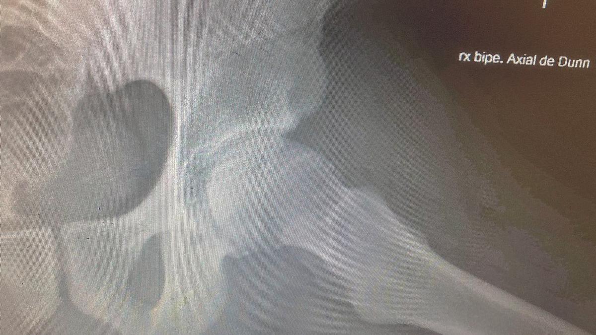 Choque Fermoroacetabular tipo CAM en paciente joven