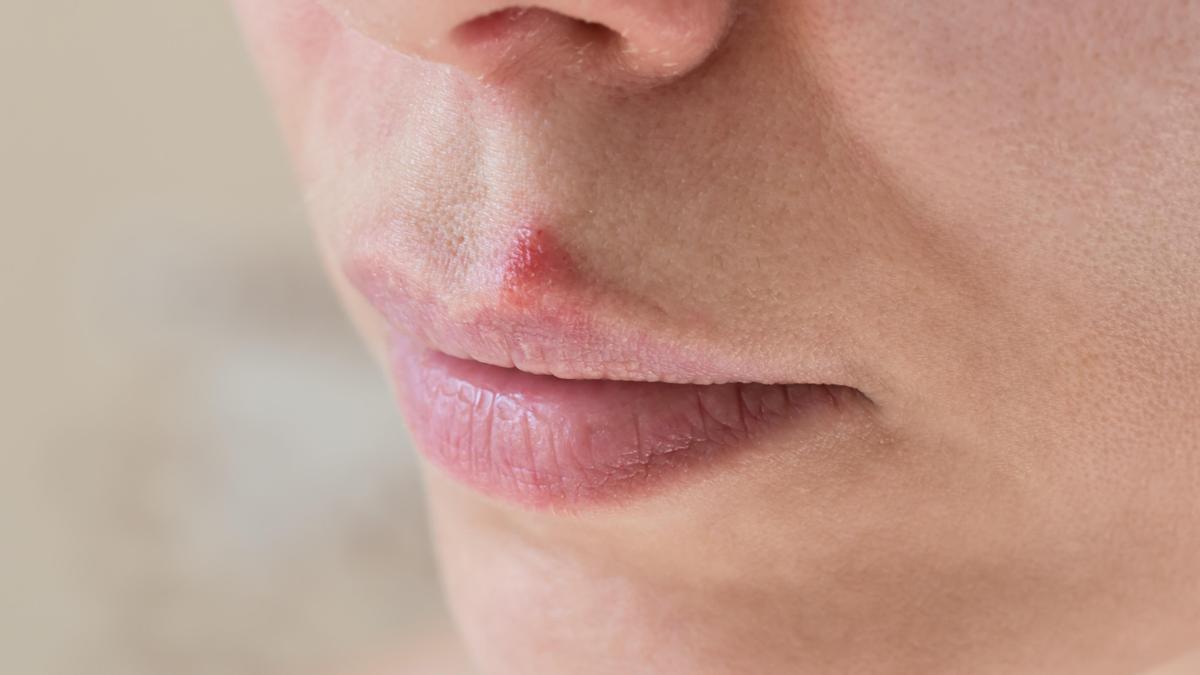 Cómo curar un herpes labial: 15 Pasos (con imágenes)