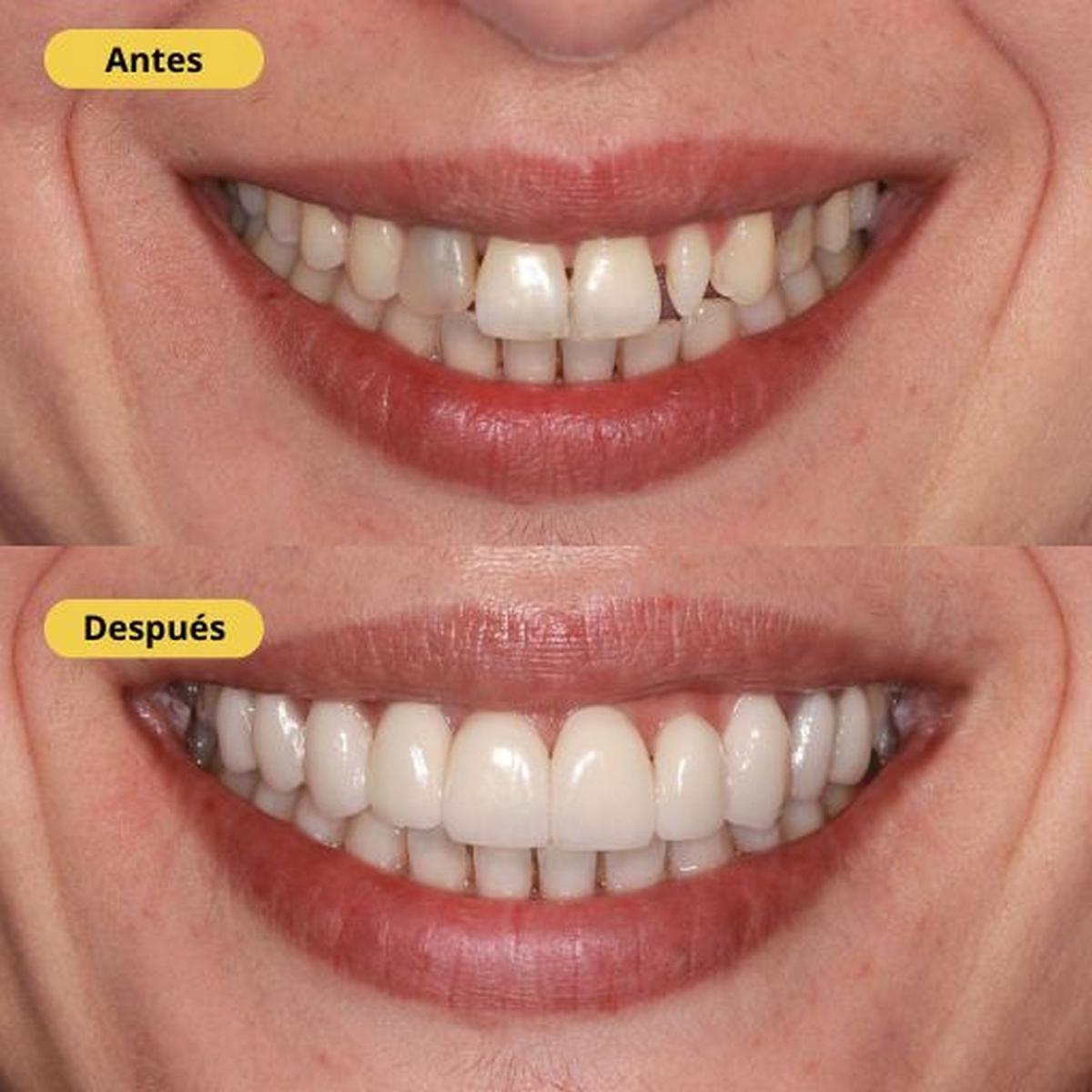 Antes y después de un tratamiento de estética dental con carillas de porcelana en IOC Clínica Dental