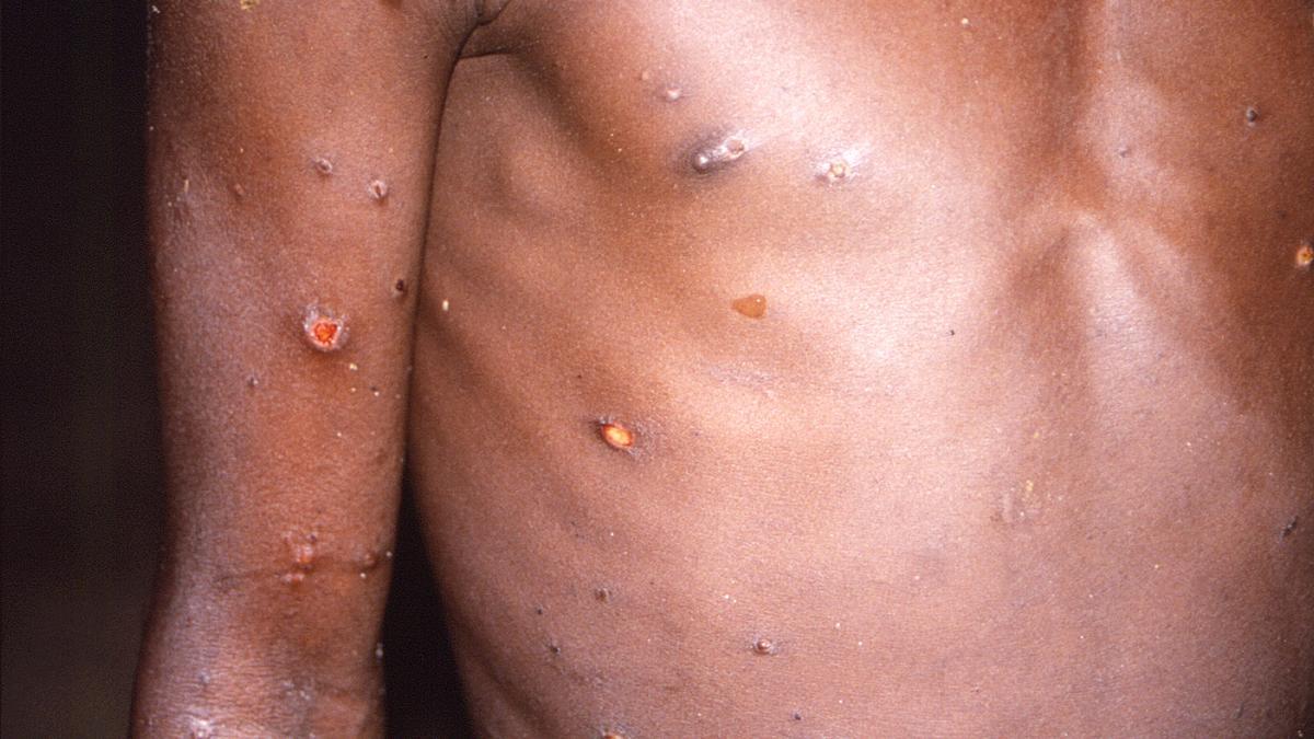 Síntomas de la viruela del mono en el cuerpo humano.