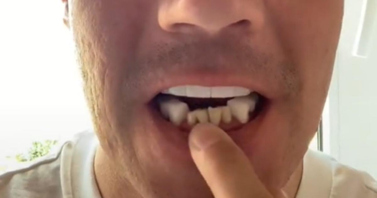 Turkey Teeth, ¿qué es la peligrosa moda que ya ha afectado a los primeros pacientes españoles?