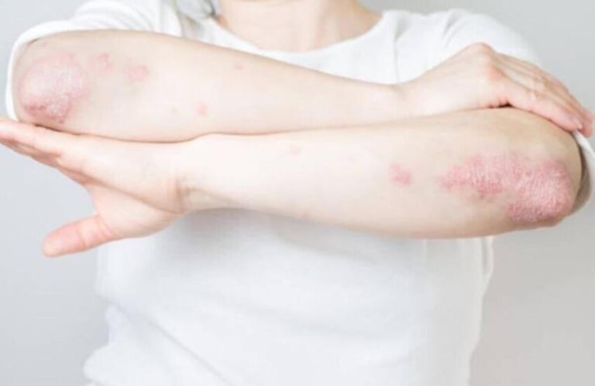 Qué es la psoriasis y qué podemos hacer para evitar el picor