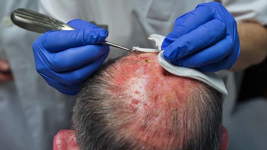 Especialistas en dermatología alertan de que el covid reduce un 50% el diagnóstico de melanoma