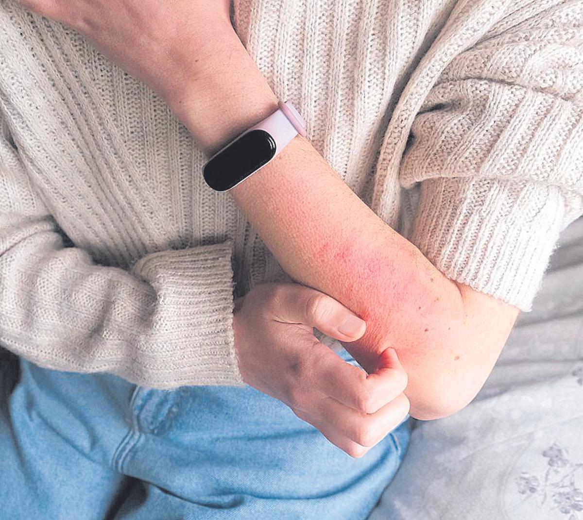 Una mujer con sarna.