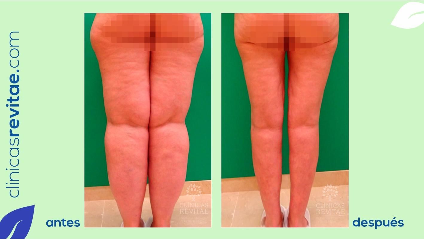 Cirugía de lipedema: muslos y fotos del progreso 