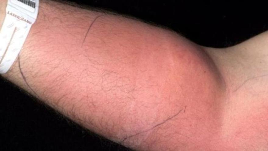 Intervenido tras inyectarse su propio semen en el brazo durante año y medio