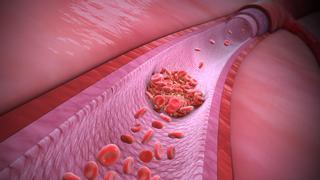 Crecen los casos de trombosis asociada al cáncer: los tumores multiplican por cuatro las posibilidades de tener un coágulo