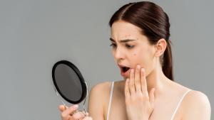 El acné, uno de los problemas que más preocupan