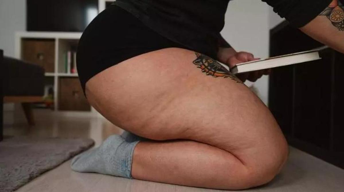 Les cames de l'Ana Ayuso, pacient de lipedema. /