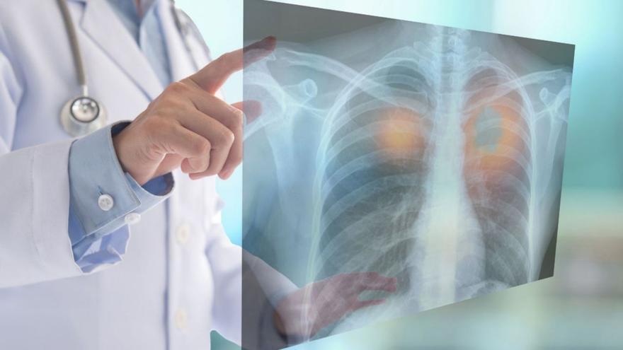 Un doctor consulta una radiografia dels pulmons en una fotografia d’arxiu. | EUROPA PRESS