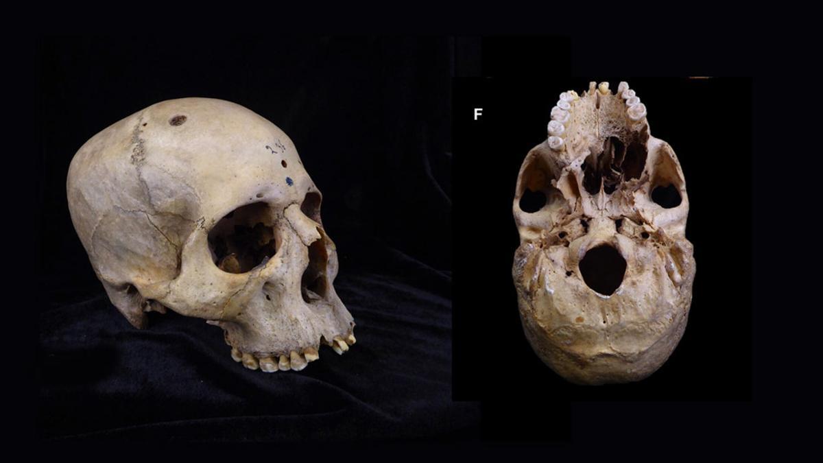 Este cráneo de un egipcio que vivió hace entre 4.300 y 4.600 años muestra rastros de un gran tumor canceroso en el paladar, así como agujeros en el cráneo debidos a metástasis óseas.