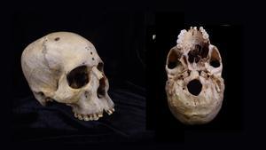 Este cráneo de un egipcio que vivió hace entre 4.300 y 4.600 años muestra rastros de un gran tumor canceroso en el paladar, así como agujeros en el cráneo debidos a metástasis óseas.