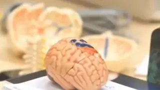 Nuevo simulador 3D para perfeccionar las cirugías de hematomas cerebrales graves en Alicante